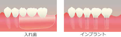 インプラントと入れ歯の比較